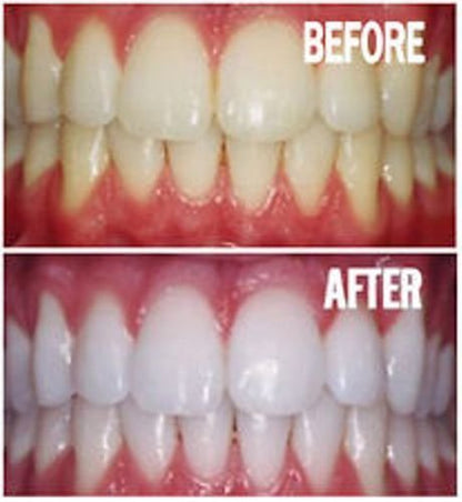 Bright White Smiles - Teeth Whitening Gel Refill Kit - 10 Tubes 44% Carbamide Peroxide Tooth Whitener Formula