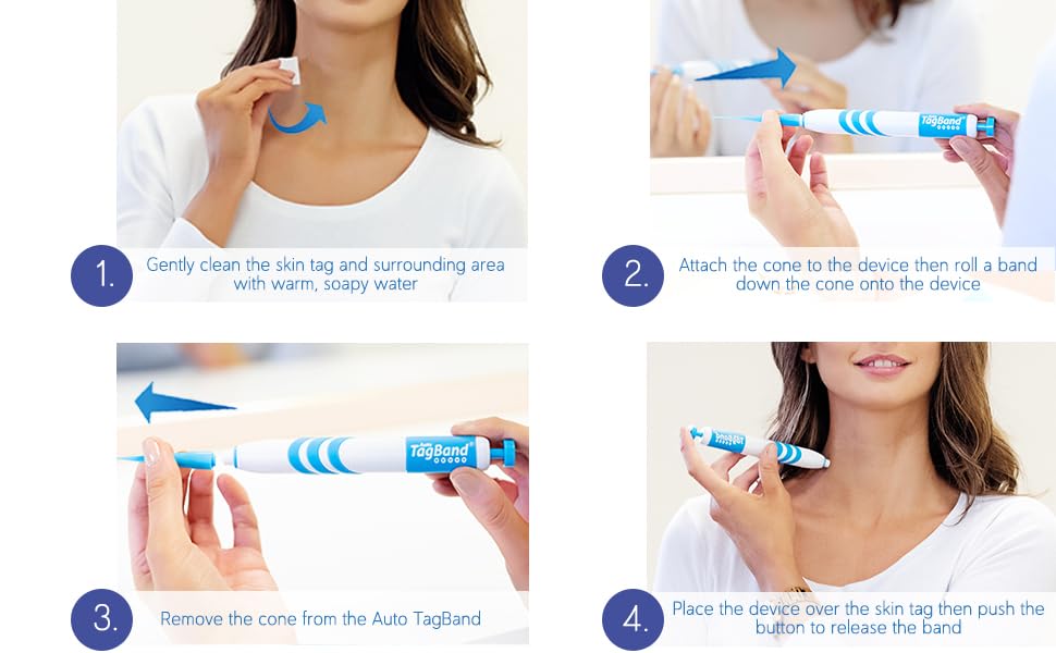 Auto Tagband Skin Tag Removal Kit, Fast Effective & Safe Remover Small/Medium Skintags (2mm-4mm) on Face Hard Reach Areas, Onehand Application Home Minutes, Includes Pen + 10 Bands