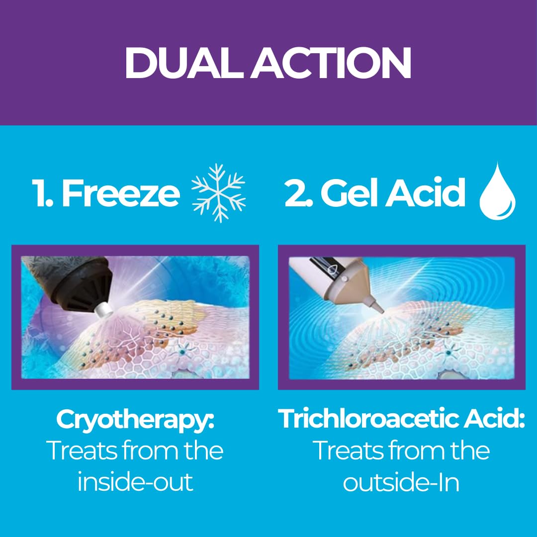Excilor Warts Duo Power Treatment - Extra Strong Effective Wart Verruca Removal - 2 Devices in 1 Box - Cryo Freeze & Acid Treatment - Hands & Feet - Effective from Day 5 - Clinically Proven