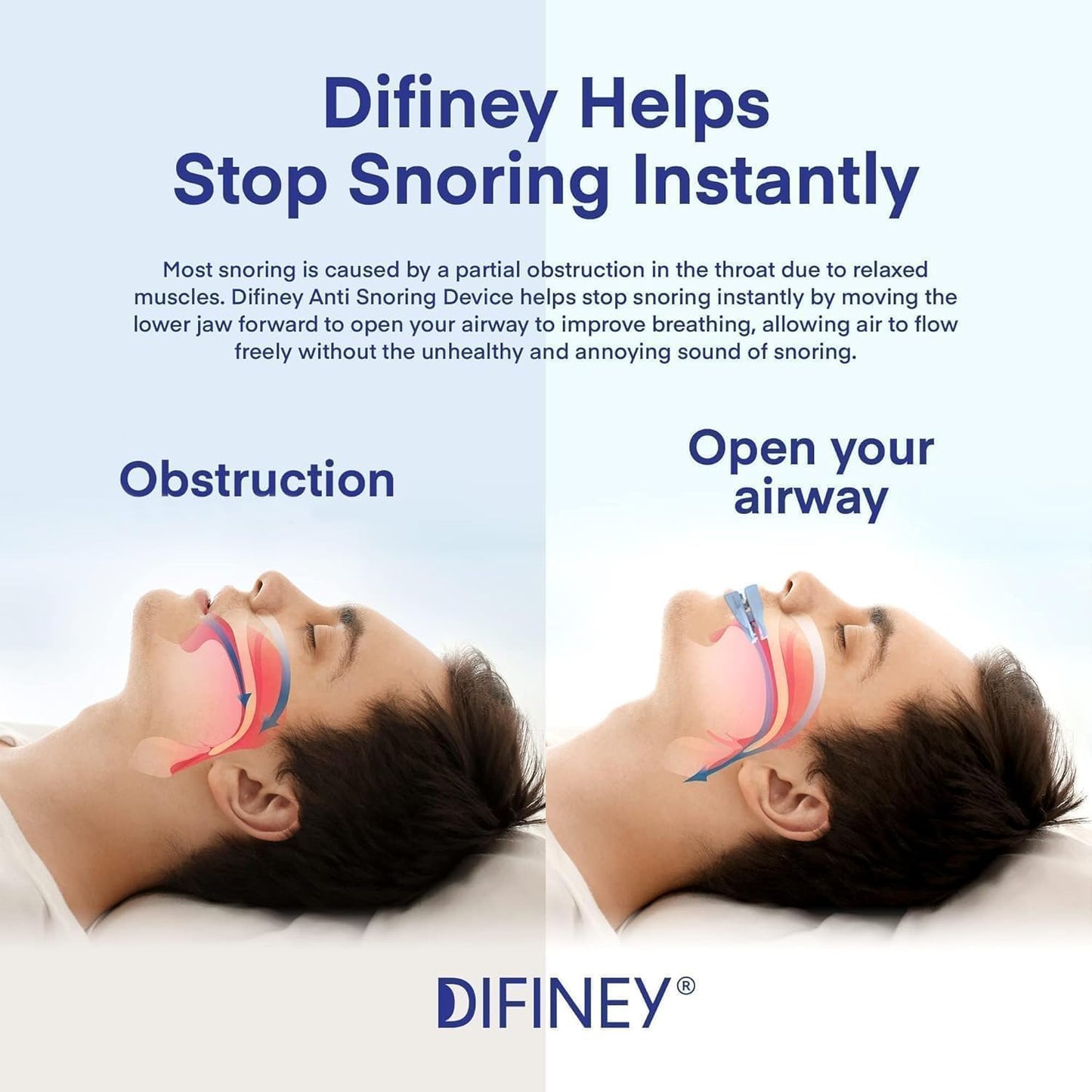 Difiney Anti Snoring Device: FDA-Cleared Anti Snoring Mouthpiece Mouth Guard - Effective Anti Snore Solution for Men and Women to Reclaim Peaceful Sleep (Blue)