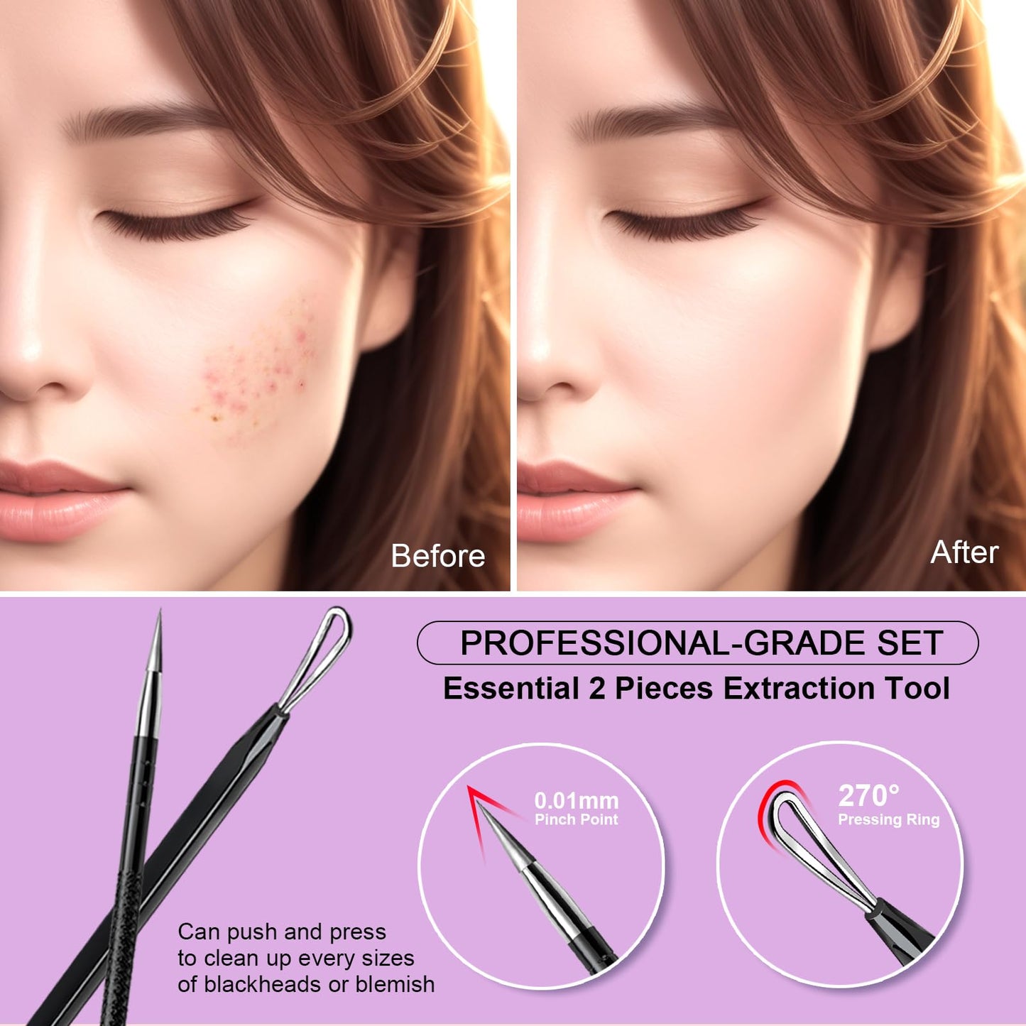 Teenitor Pimple Extractor Acne Treatment Tool Surgical Grade Blackhead Comedone Removal 2-in-1 Popper Tool for Face Nose Blackhead Extractor Tool Silver