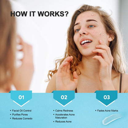 Acne Pimple Spot Treatment Cream: Cystic Hormonal Blackheads Blemish Remover for Face, Back and Body - with 10% Azelaic Acid - Teens 13-19 & Young Adult 20-30, 1.8 oz