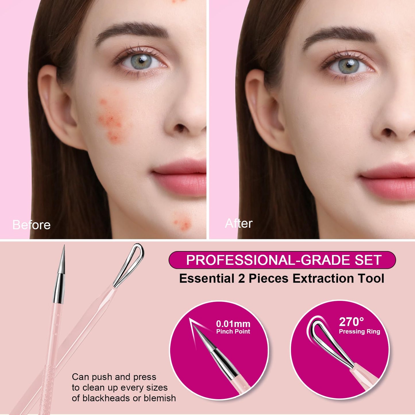 Teenitor Pimple Extractor Acne Treatment Tool Surgical Grade Blackhead Comedone Removal 2-in-1 Popper Tool for Face Nose Blackhead Extractor Tool Silver