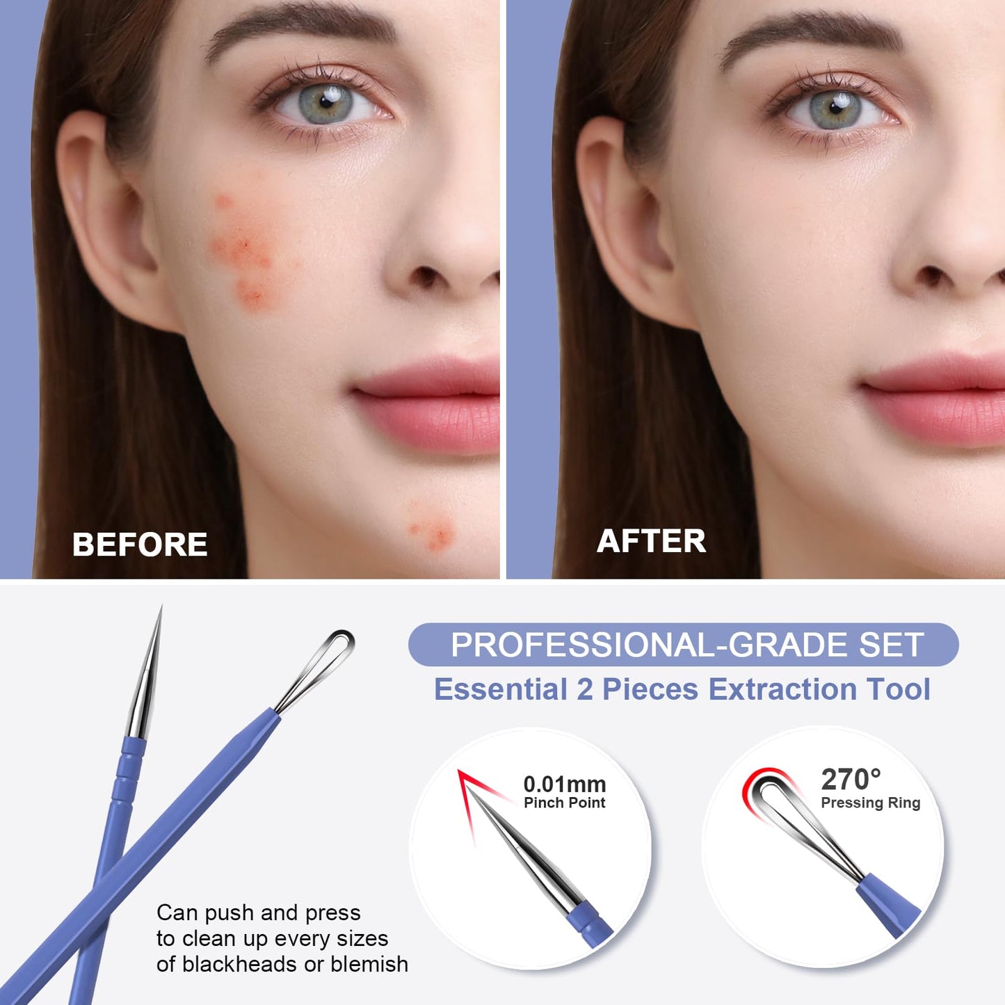 Teenitor Pimple Extractor Acne Treatment Tool Surgical Grade Blackhead Comedone Removal 2-in-1 Popper Tool for Face Nose Blackhead Extractor Tool Silver