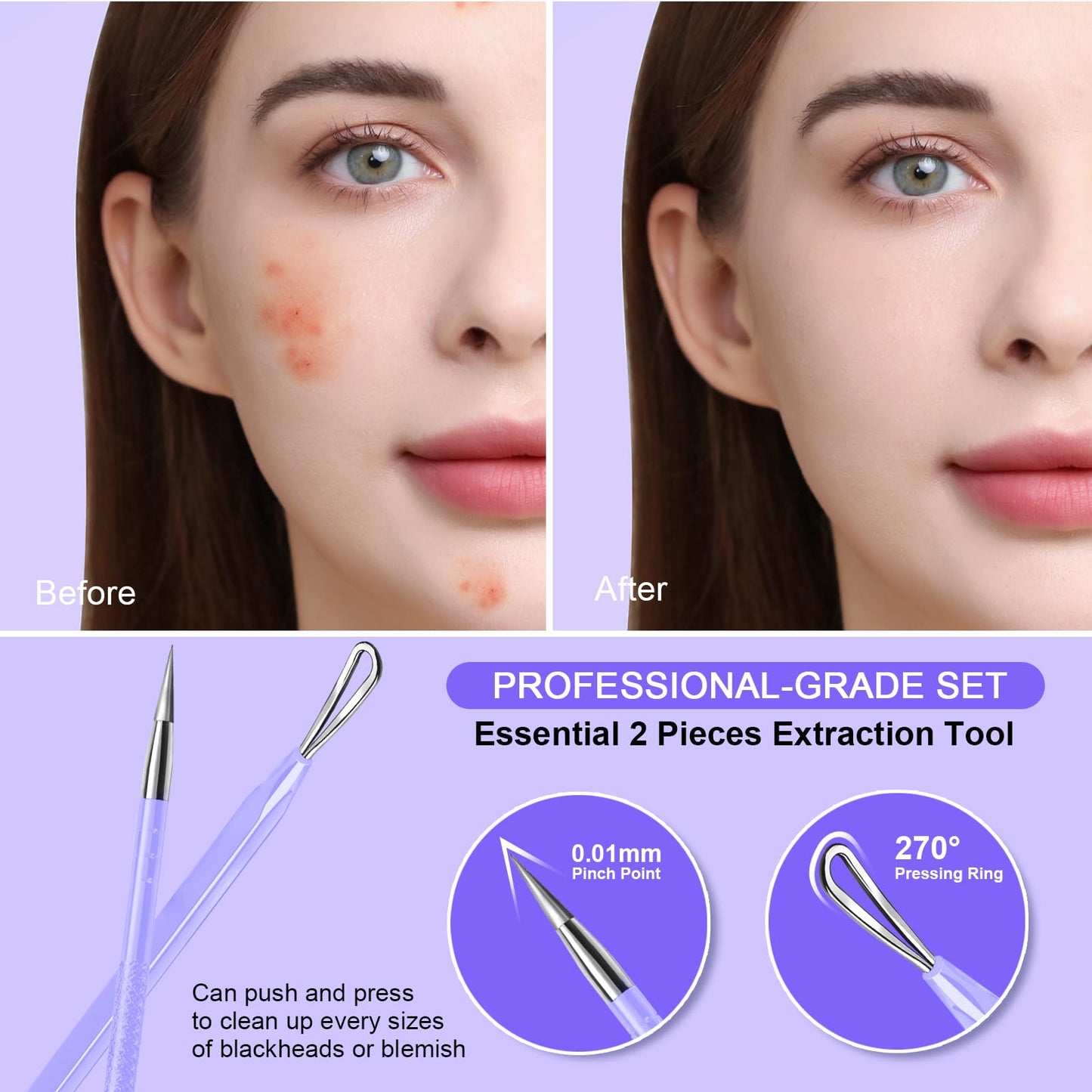 Teenitor Pimple Extractor Acne Treatment Tool Surgical Grade Blackhead Comedone Removal 2-in-1 Popper Tool for Face Nose Blackhead Extractor Tool Silver