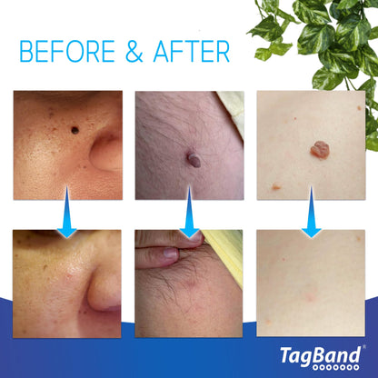 Auto Tagband Skin Tag Removal Kit, Fast Effective & Safe Remover Small/Medium Skintags (2mm-4mm) on Face Hard Reach Areas, Onehand Application Home Minutes, Includes Pen + 10 Bands
